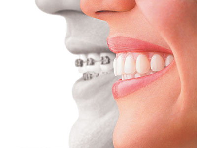 The image shows a side-by-side comparison of a person s natural smile with an artificial dental implant, illustrating the difference between the two.