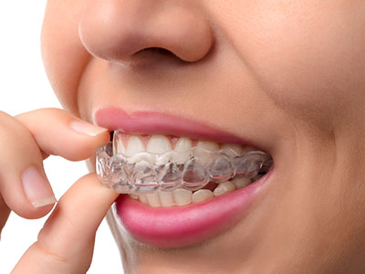 The image shows a person wearing clear braces, adjusting them with their fingers.