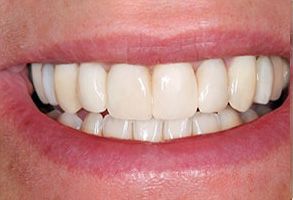 The image shows a close-up of a person s smiling mouth with white teeth and pink gums.