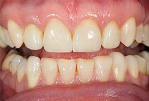 The image shows a close-up of a person s teeth with significant discoloration and staining, particularly noticeable on the front teeth, which are yellowed and have darker stains.