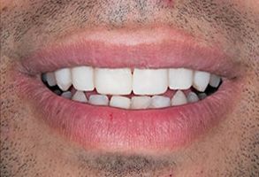 The image shows a close-up of a person s mouth with teeth, smiling at the camera.