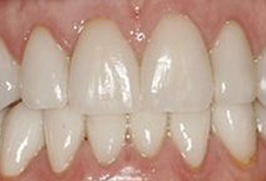 The image shows a close-up view of a person s teeth with an emphasis on a large gap between two front teeth, which are prominently visible against the backdrop of other teeth.