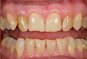 The image shows a close-up view of two sets of teeth with yellow stains, one on the left appearing cleaner than the other, which has a pinkish hue.