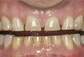 The image shows a close-up of a person s teeth with a visible gap between them, which appears to be held together by metal clamps.
